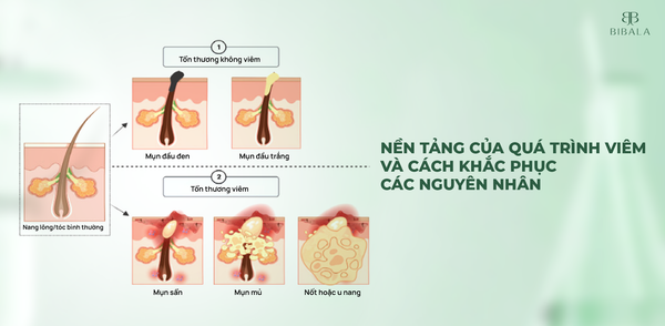 NỀN TẢNG CỦA QUÁ TRÌNH VIÊM VÀ CÁCH KHẮC PHỤC CÁC NGUYÊN NHÂN
