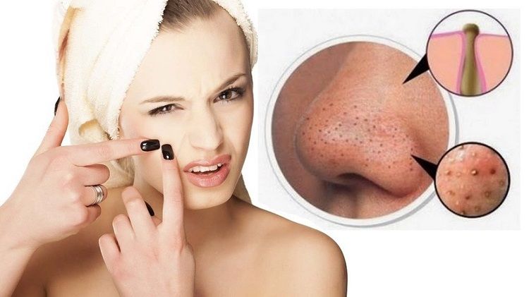 Cách trị mụn đầu đen và lỗ chân lông to hiệu quả