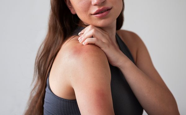 Da đau rát như bị bỏng là bị gì? Cách khắc phục ra sao?