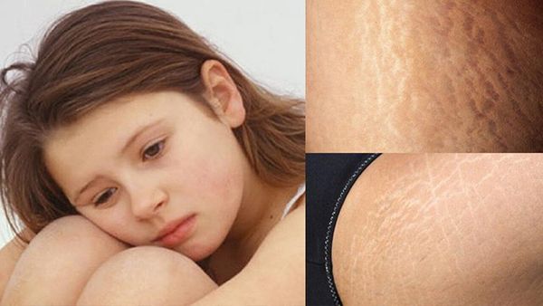 Tại sao bị rạn da ở tuổi dậy thì?