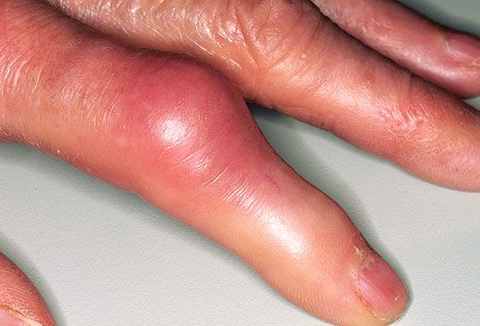 7 lời khuyên cho người bị mắc bệnh Gút hay Gout