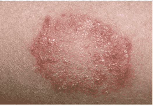 Nấm RingWorm Gây Viêm Da
