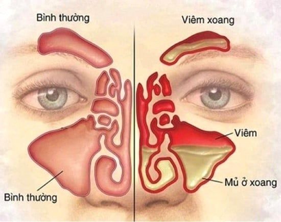 Báo cáo trường hợp: Điều trị viêm xoang đa kháng thuốc