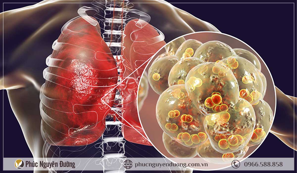 Đông trùng hạ thảo tốt cho người mắc bệnh phổi nhưng nên sử dụng sao cho đúng?