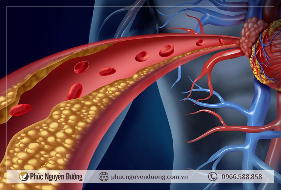 Cholesterol cao gây bệnh gì? Cần làm gì để giảm cholesterol trong máu