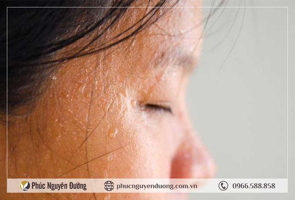 Cơ thể đổ mồ hôi nhiều là bệnh gì? Cách giảm ra mồ hôi nhiều tại nhà