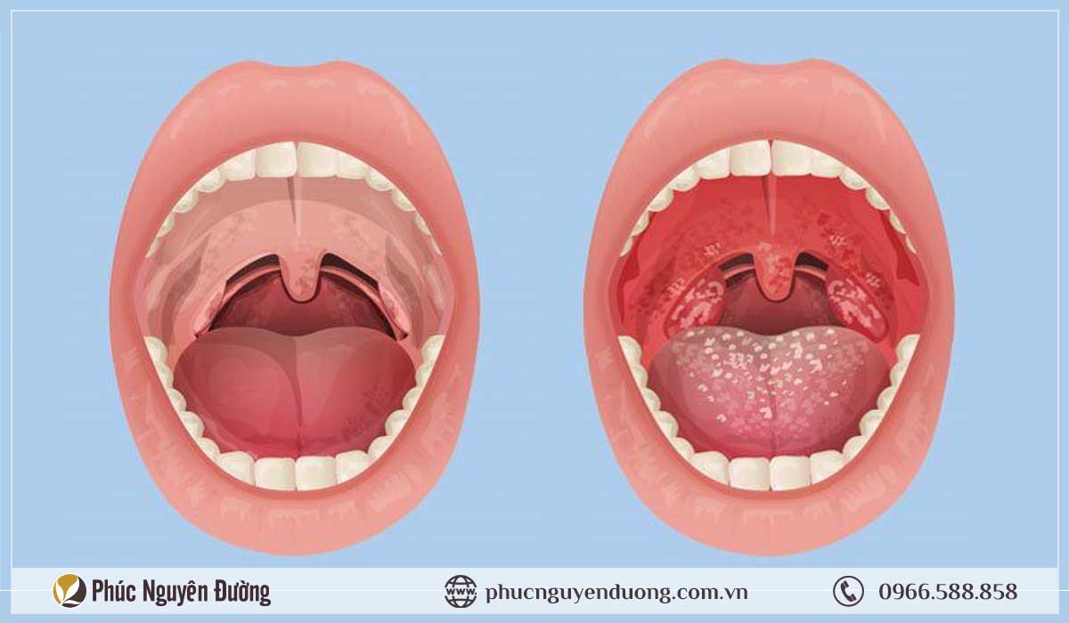 6 Cây thuốc chữa viêm họng hiệu quả tức thì, không nên bỏ qua