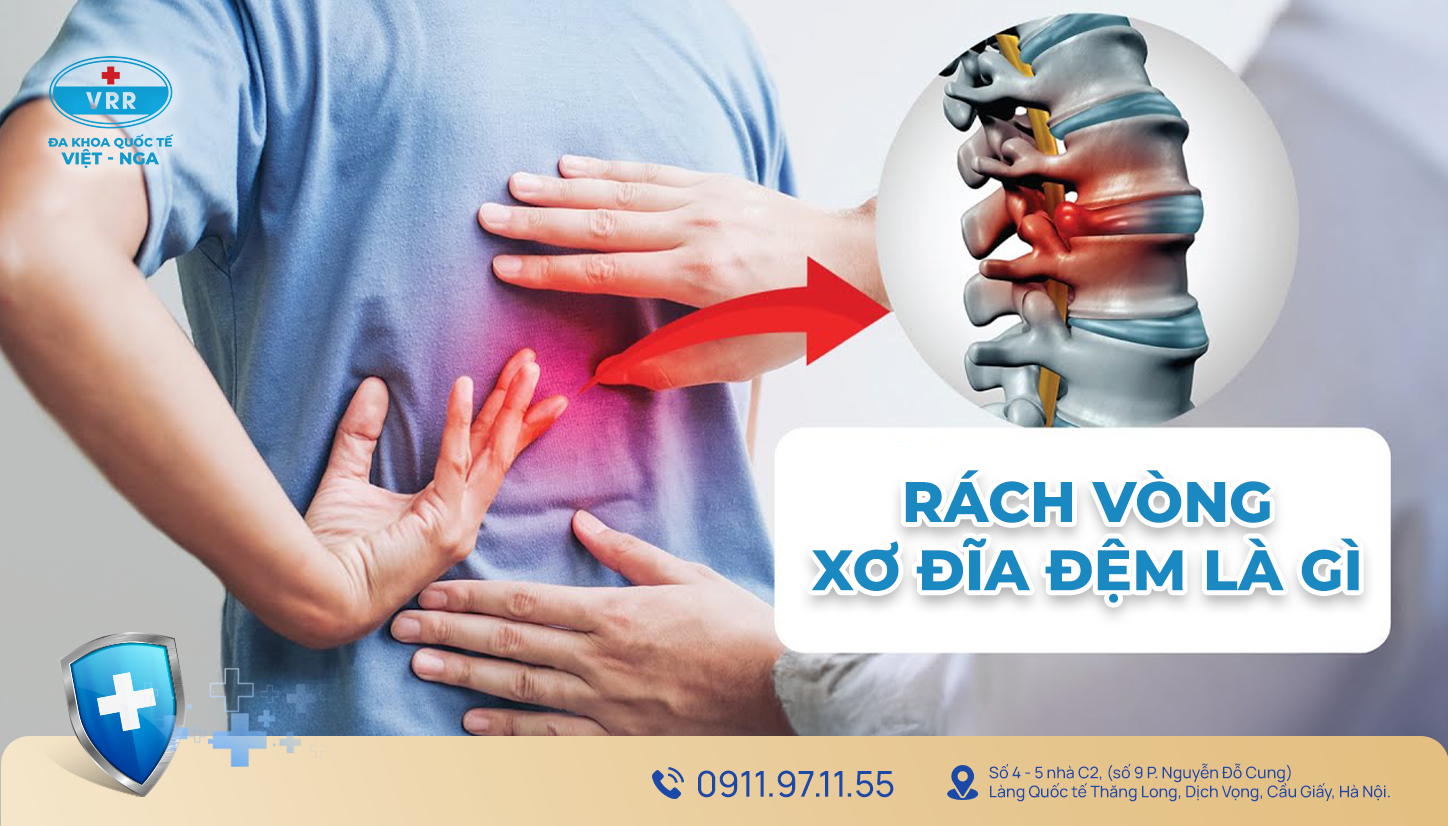 RÁCH VÒNG XƠ ĐĨA ĐỆM: NGUYÊN NHÂN, TRIỆU CHỨNG VÀ PHƯƠNG PHÁP ĐIỀU TRỊ ...