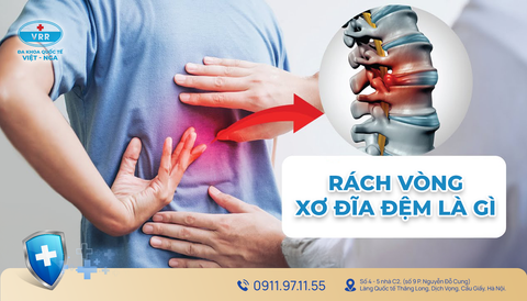RÁCH VÒNG XƠ ĐĨA ĐỆM: NGUYÊN NHÂN, TRIỆU CHỨNG VÀ PHƯƠNG PHÁP ĐIỀU TRỊ