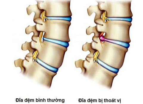 Thoát vị đĩa đệm - Nguyên nhân, triệu chứng và cách điều trị