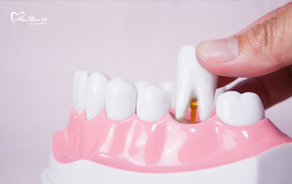Trồng răng sứ có sử dụng vĩnh viễn được không ?