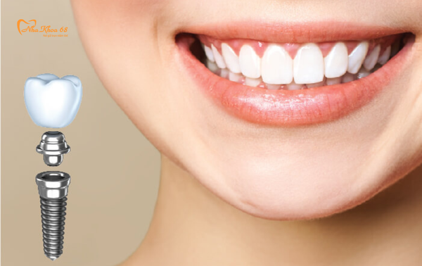 Quy trình chuẩn trồng răng implant an toàn, thẩm mỹ