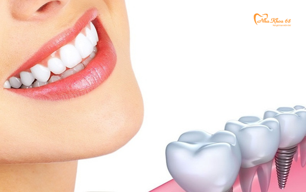 Những điều cần biết về cấy ghép Implant