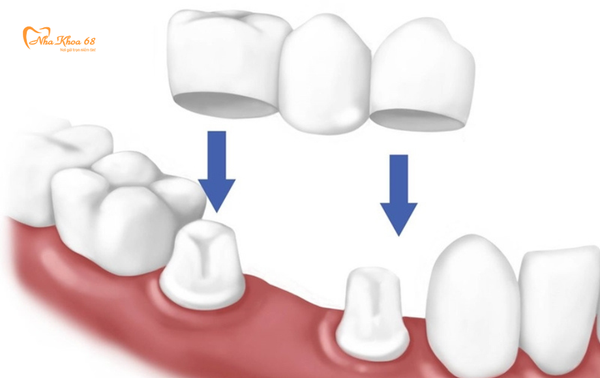 Cầu răng là gì?
