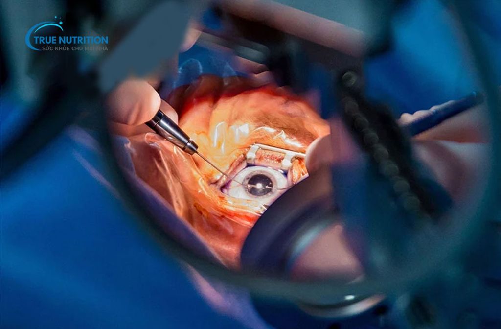 Tác Hại Của Việc Mổ Mắt Cận Thị: Những Điều Cần Biết Trước Khi Quyết Định Phẫu Thuật