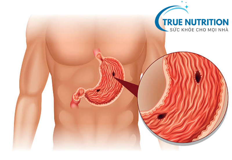 Loét Hành Tá Tràng Có Nguy Hiểm Không? Những Nguy Cơ Tiềm Ẩn!