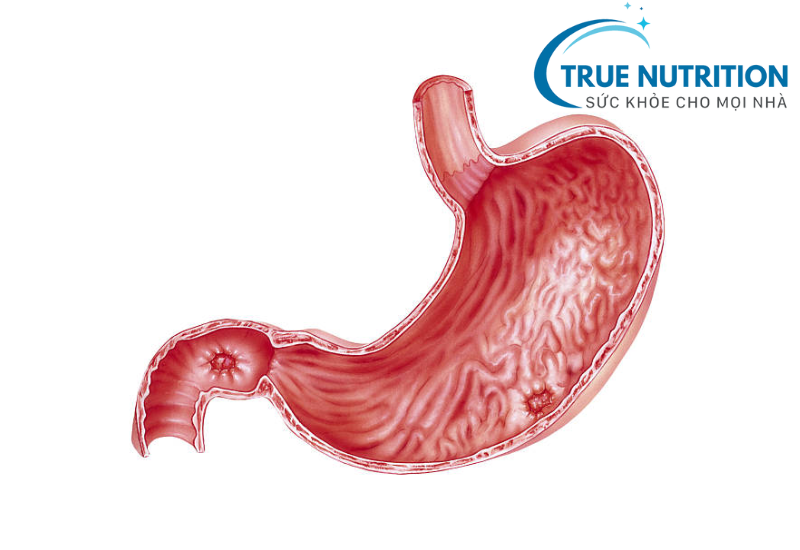 Loét Dạ Dày Có Tự Khỏi Được Không? Câu Trả Lời Nào Đúng?