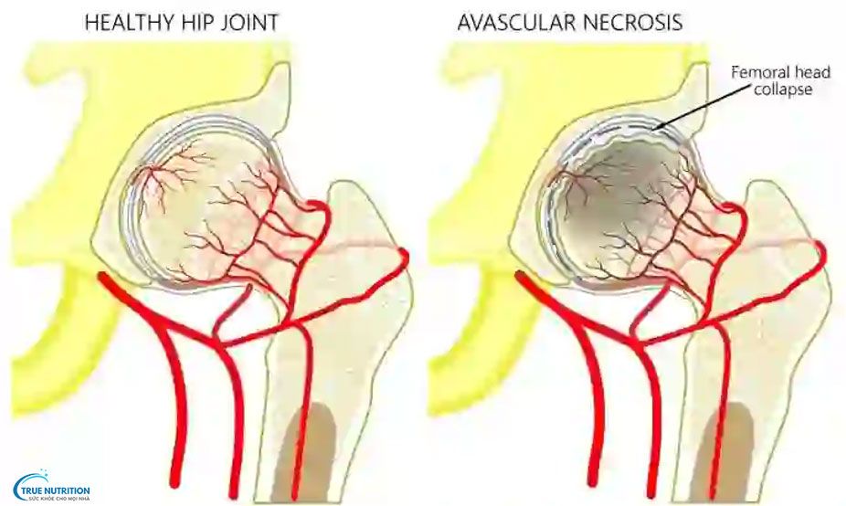 Chỏm Xương Đùi Là Gì? Hoại Tử Chỏm Xương Đùi Là Gì? Dấu Hiệu, Điều Trị, Bài Tập
