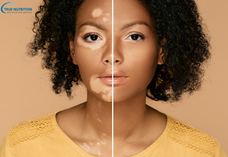 Dấu Hiệu Bệnh Bạch Biến: Nhận Biết Sớm Để Bảo Vệ Làn Da Của Bạn