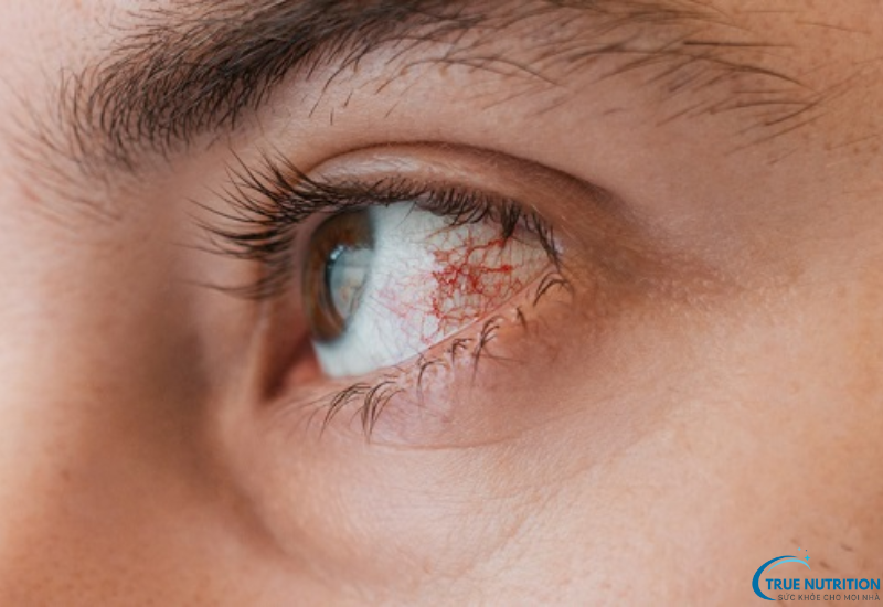 Bệnh glôcôm là gì? Những điều cần biết để bảo vệ thị lực của bạn