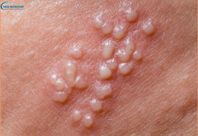 Dấu hiệu bệnh Herpes sinh dục: Làm sao phát hiện và phòng tránh