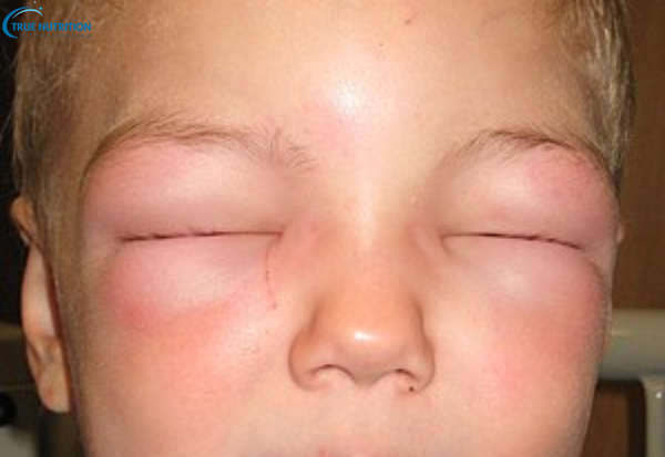 Bệnh Phù Mạch Là Gì? Những Điều Bạn Cần Biết Để Xử Lý Kịp Thời