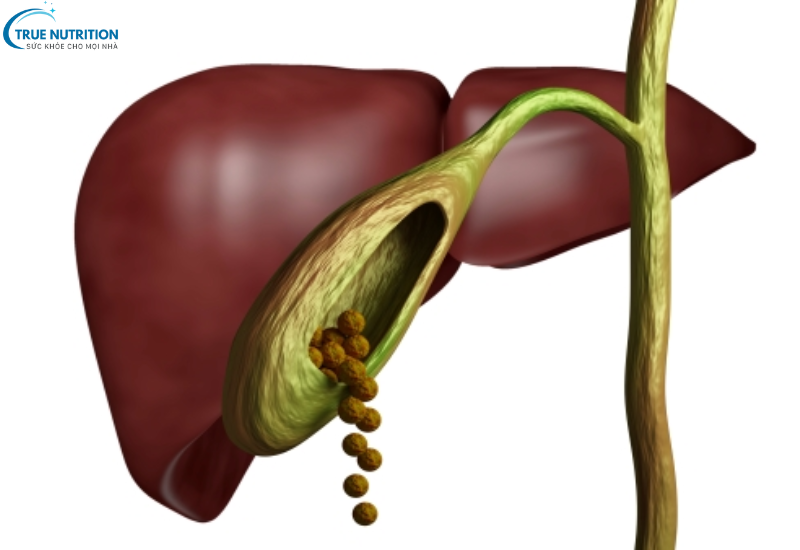 Triệu Chứng Bệnh Sỏi Mật: Các Biểu Hiện Cảnh Báo Bạn Cần Lưu Ý Ngay