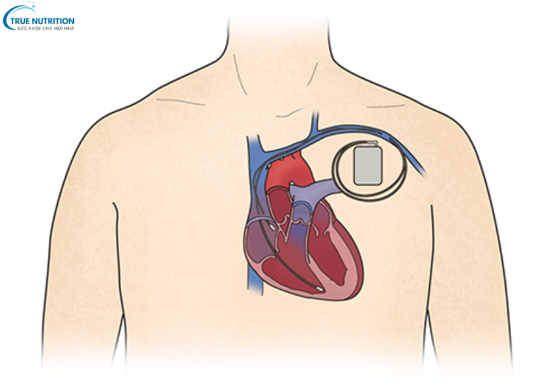 Triệu Chứng Bệnh Suy Tim: Dấu Hiệu Cảnh Báo Bạn Không Nên Bỏ Qua