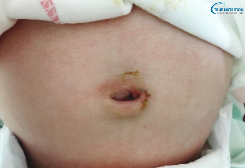 Bệnh U Hạt Rốn: Những Điều Cần Biết Và Phương Pháp Xử Lý An Toàn