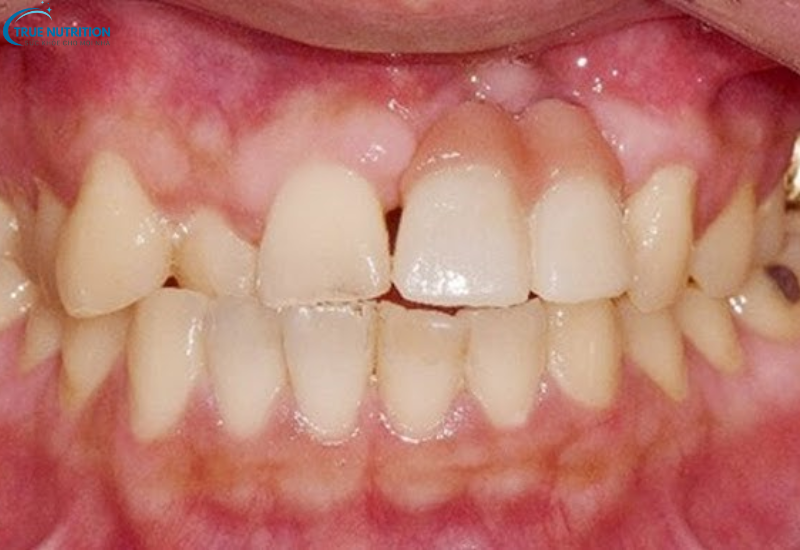 Bệnh U Nang Răng Là Gì? Nguyên Nhân, Dấu Hiệu Và Cách Phòng Ngừa
