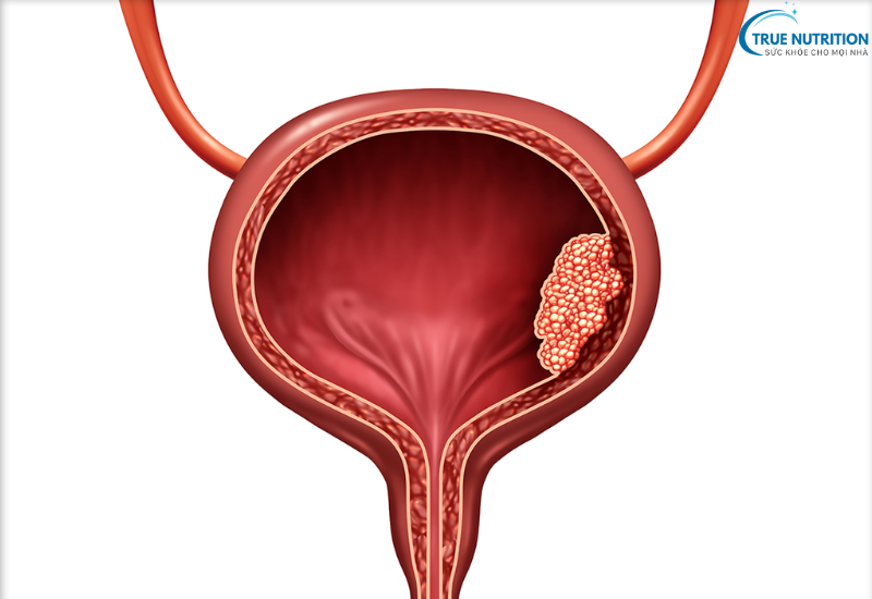 Dấu Hiệu Bệnh Ung Thư Bàng Quang : Cảnh Báo Từ Những Biểu Hiện Đầu Tiên