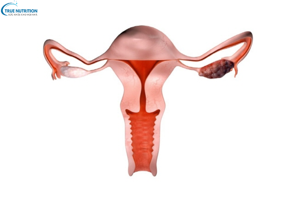 Dấu Hiệu Bệnh Ung Thư Buồng Trứng: Cách Nhận Biết Và Phòng Ngừa Sớm