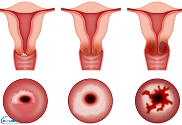 Dấu Hiệu Bệnh Ung Thư Cổ Tử Cung: Nhận Diện Sớm Để Chủ Động Điều Trị