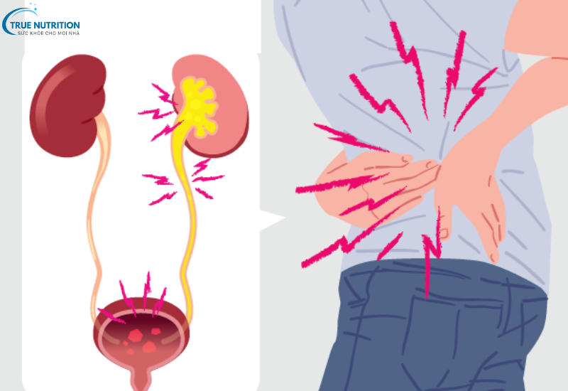 Dấu Hiệu Bệnh Ung Thư Thận: Nhận Biết Sớm Để Chủ Động Điều Trị