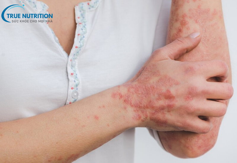 Bệnh Vảy Nến Là Gì? Cách Kiểm Soát Và Phòng Ngừa Hiệu Quả Nhất