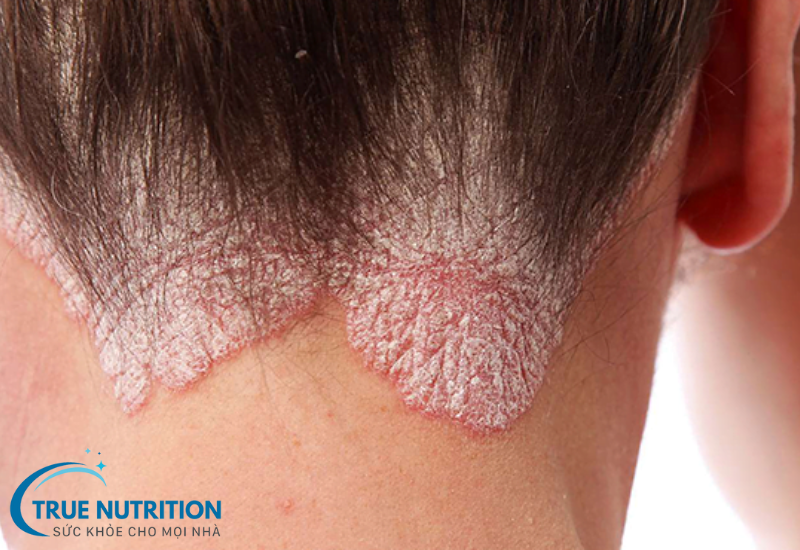 Bệnh vảy nến: Những điều cần biết về nguyên nhân và triệu chứng