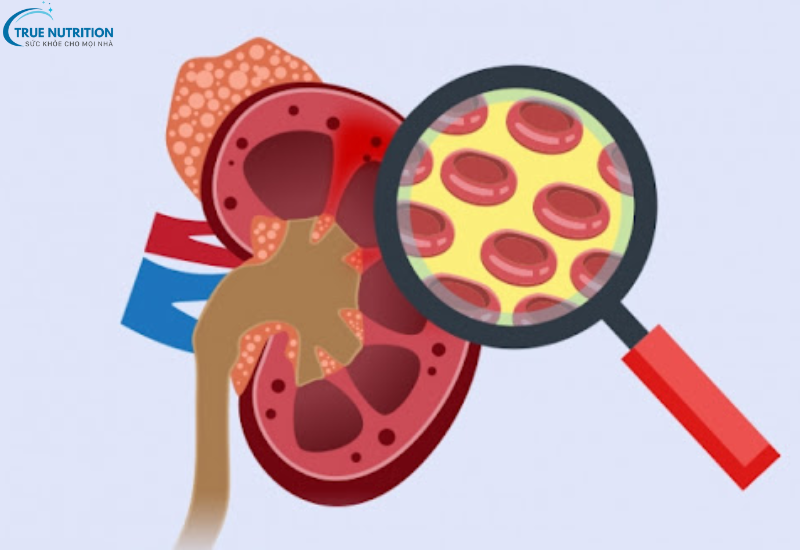 Bệnh Viêm Cầu Thận: Hiểu Đúng Bệnh Lý Và Giải Pháp Điều Trị Hiệu Quả