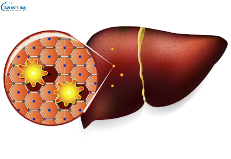 Dấu hiệu bệnh viêm gan B: Những triệu chứng không nên bỏ qua