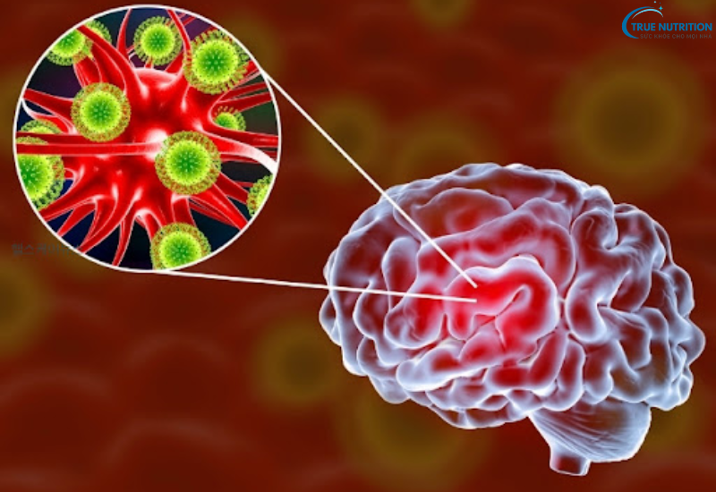 Dấu hiệu bệnh viêm màng não: Những triệu chứng không thể bỏ qua