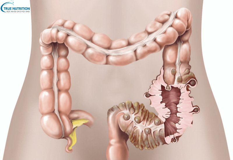Bệnh viêm túi thừa là gì? Triệu chứng nhận biết và cách điều trị