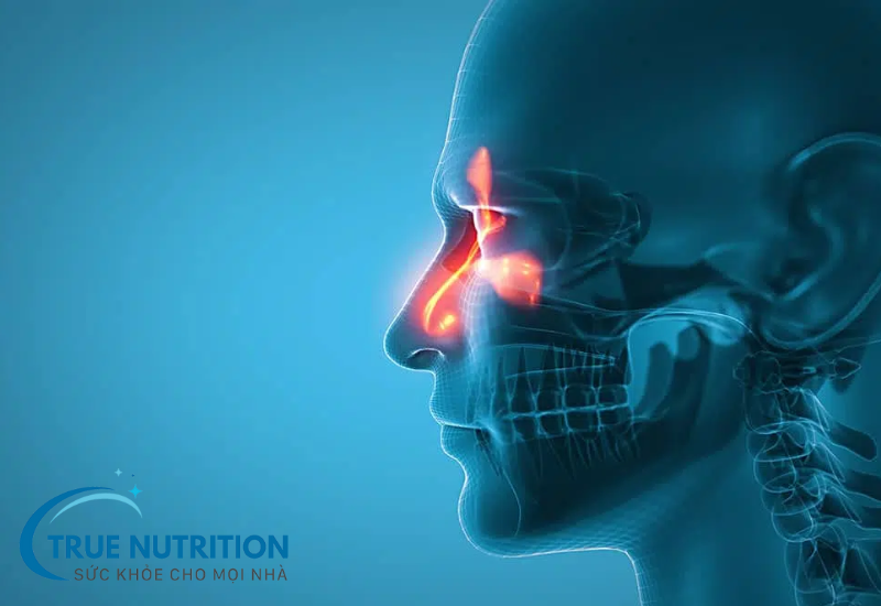 Bệnh Viêm Xoang Mũi – Nguyên Nhân, Triệu Chứng và Cách Điều Trị