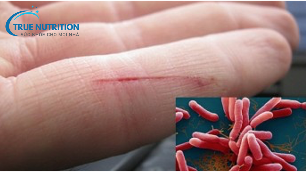 Bệnh Whitmore: Sát Thủ Thầm Lặng