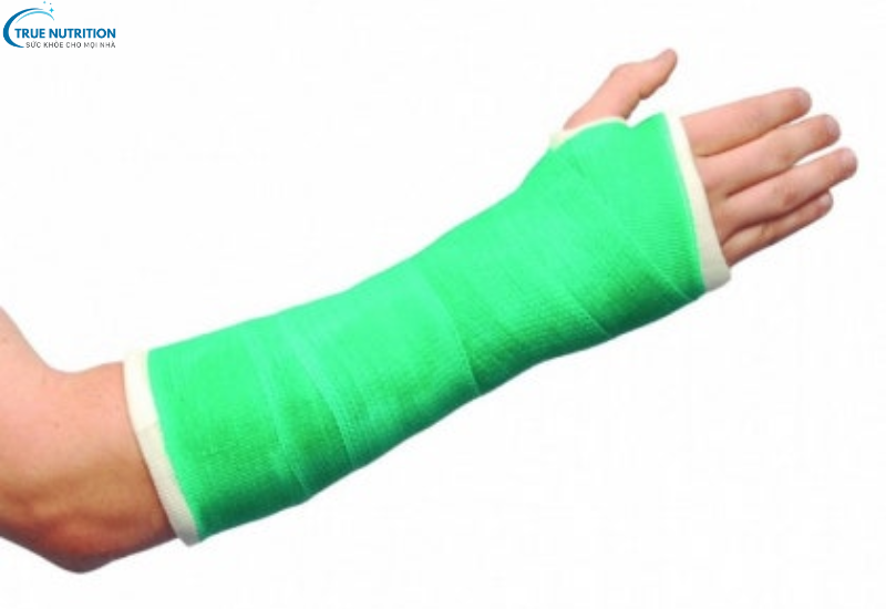 Biến Chứng Bó Bột: Hướng Dẫn Chăm Sóc Để Tránh Rủi Ro Sức Khỏe