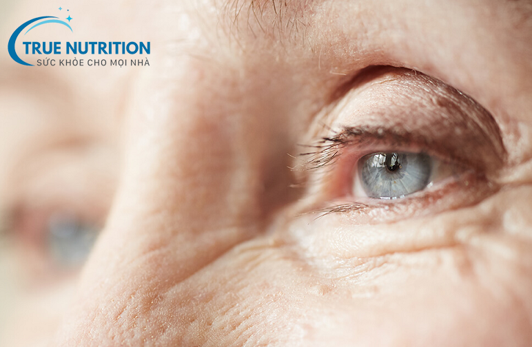 Biến chứng đục thủy tinh thể ở người tiểu đường: Hiểu rõ để phòng ngừa hiệu quả