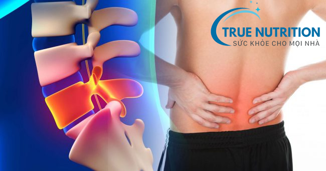 Bệnh thoái hóa cột sống: dấu hiệu, nguyên nhân, biến chứng, cách điều trị và phòng ngừa