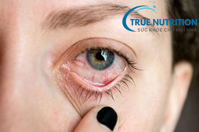 Biến Chứng Tiểu Đường Lên Mắt: Cảnh Báo Sớm và Phương Pháp Điều Trị Hiệu Quả