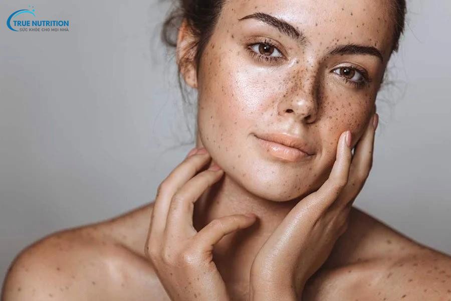 Bớt Hori Là Gì, Có Chữa Được Không, Xuất Hiện Ở Độ Tuổi Nào?