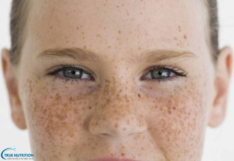 Các Loại Bệnh Nám Da: Các Dạng Nám Phổ Biến và Cách Phòng Ngừa