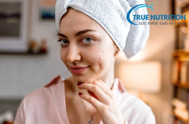 Da Mụn, Da Dầu Không Còn Là Nỗi Lo: Cách Chăm Sóc Da Đúng Cách