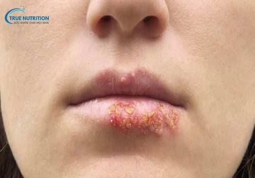 Cách Chữa Nổi Hạt Fordyce Trên Môi: Mẹo, Công Nghệ, Sinh Hoạt